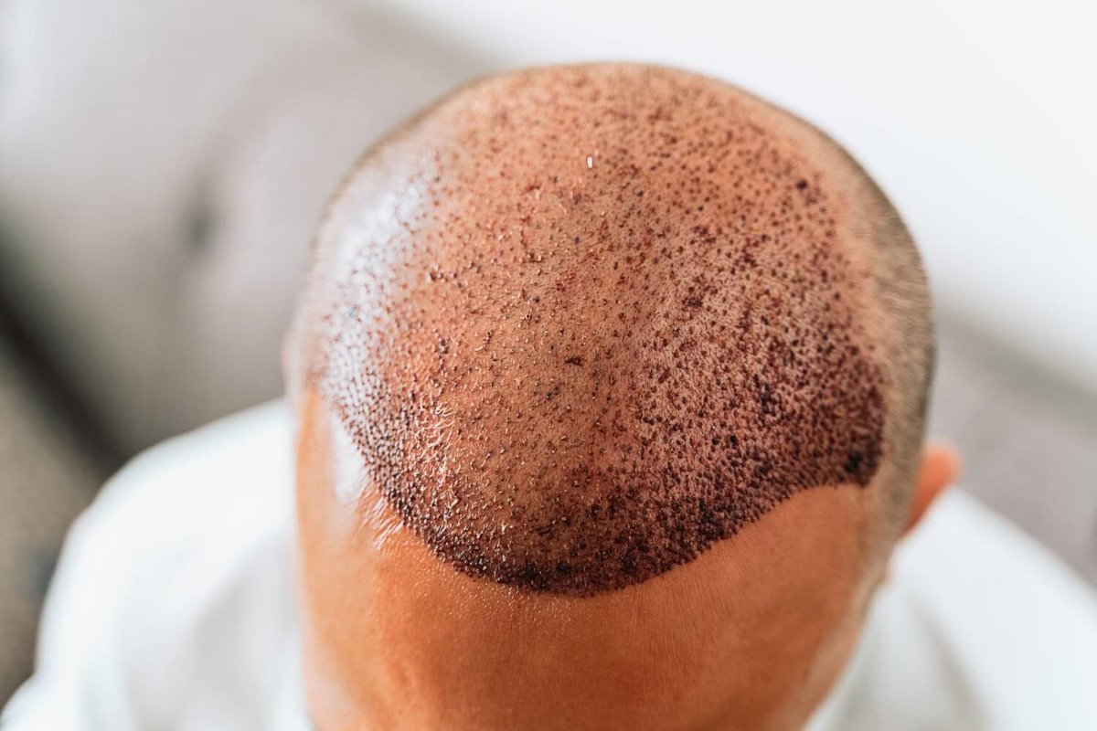 Istanbul: Waarom is het de Haartransplantatiehoofdstad van de Wereld?